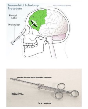 Lobotomy.jpg