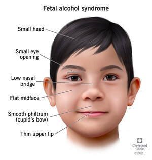 15677-fetal-alcohol-syndrome.jpg