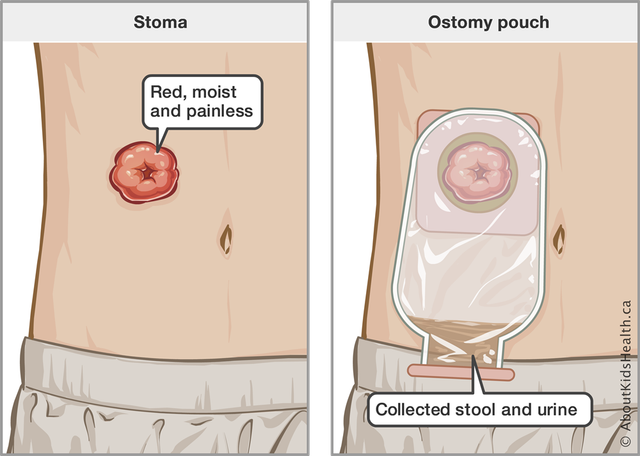 Ostomy-Pouch-Copy.png